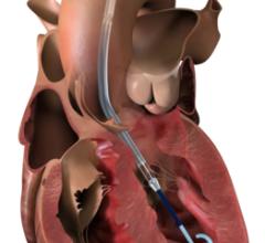 The Impella CP with SmartAssist heart pump is a minimally invasive, temporary heart pump that uses real-time intelligence associated with improved survival and heart recovery. (Graphic: Business Wire)