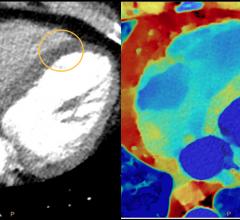 Illustration of how spectral CT can help confirm findings on a conventional CT scan without requiring follow-up imaging, such as a nuclear scan. The conventional CT on the left, and the dual-energy CT on the right confirms an infarct.
