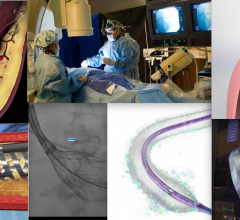 Key Interventional Cardiology and structural heart Technologies to Prepare for TCT 2017.