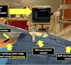  At Mayo, they have a small, tableside-mounted ultrasound console in the cath labs that is used for both radial and femoral vascular access. Table set up with the patient includes a sterile marker, a hemostat for marking the lower edge of the femoral head using fluoroscopy, a micropunture needle, and a still micropunture sheath.