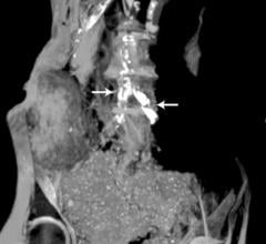 CT scan showing Egyptian mummy with calcified aortic bifurcation.