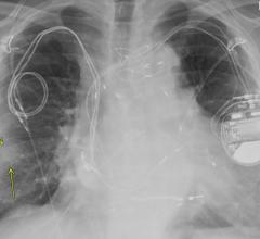 Chest X-ray, posteroanterior view, of a 79-year-old man with history of a previous pacemaker, with abandoned right atrial and right ventricular pacing leads on the right side at time of new cardiac resynchronization therapy defibrillator implant on the left side. Arrows indicate a nodular opacity in the right midlung concerning for mass. Find more images of patients in this study in Radiology: Cardiothoracic Imaging.