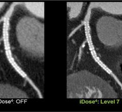 An example of iterative reconstruction image reconstruction to improve the image quality of low dose CT scans to enable lower dose imaging