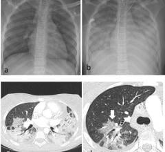Thoracic findings in a 15-year-old girl with Multisystem Inflammatory Syndrome in Children (MIS-C). (a) Chest radiograph on admission shows mild perihilar bronchial wall cuffing. (b) Chest radiograph on the third day of admission demonstrates extensive airspace opacification with a mid and lower zone predominance. (c, d) Contrast-enhanced axial CT chest of the thorax at day 3 shows areas of ground-glass opacification (GGO) and dense airspace consolidation with air bronchograms. (c) This conformed to a mosai
