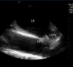 An example of intra-cardiac echo (ICE) imaging showing two of the pulmonary veins, anatomical landmarked used during ablation procedures to treat atrial fibrillation. This example is from the ICE system used by St. Jude Medical. 