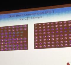 A comparison of SPECT scanner photo-multiplier technology vs. the newer CZT detector SPECT technology, showing improvement in image clarity.
