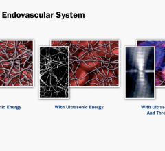  Primary tabs View(active tab) Edit Delete Revisions Entityqueue Devel Open configuration options Open configuration options Videos | Venous Therapies | June 27, 2017 VIDEO: How the Ekos Thrombolytic Technology Works to Dissolve Clots Open Related Chest Pain Imaging Content: configuration options Venous Thrombolytic System Demonstration  Play  Mute Remaining Time -3:23  Picture-in-Picture  Fullscreen This video, provided by Ekos, demonstrates the EkoSonic endovascular System thrombolytic system to treat dee