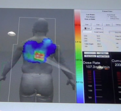 Toshiba is developing a radiation dose alert to show interventionalists how much dose they have delivered to their patient from X-ray angiography.