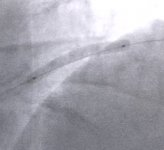 cath lab clinical trial study pharmaceuticals antiplatelet therapy arctic