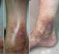 A patient case study showing a venous ulcer formation 18 months following thermal ablation varicose vein treatment in the GSV. The patient was treated with Varithena polidocanol endovenous microfoam chemical-ablation. Images show baseline prior to treatment (right), followed by one, four and six weeks after treatment. The treatment is also called sclerotherapy.