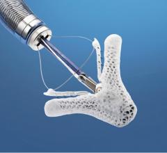 The Abbott Mitraclip device for transcatheter treatment of mitral valve regurgitation.