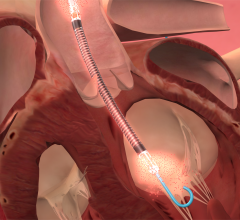 the Impella pVAD improves survival, mortality in AMI heart attack with cardiogenic shock