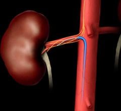 An example of renal denervation therapy being delivered. A catheter is inserted into the renal artery to ablate the nerves in the vessel wall that regulate vasoconstriction. This leaves the vessel permanently in the widest open position to allow greater blood flow to the kidneys.