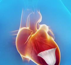 CardioKinetics PARACHUTE IV Clinical Trial Heart Failure Treatments