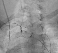 Claret embolic protection, TAVR, cerebral protection