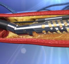 The Medtronic's TurboHawk atherectomy system. Covidien, Medtronic, TurboHawk, Atherectomy system