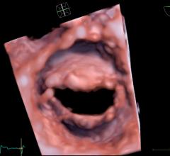 Mitral Valve, cardiovascular ultrasound, GE E95, cardiac ultrasound, comparison of ultrasound systems
