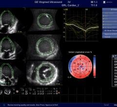 GE Healthcare's cardiac ultrasound strain assessment software helps quantify left ventricular wall motion to determine if there is damage to cardiac function due to cancer therapy. GE Ultrasound, GE echo, strain, cardio-oncology