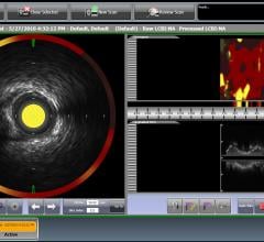near-infrared spectroscopy, NIRS, heart attack, stroke, Infraredx, TVC