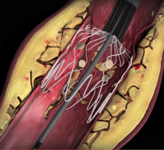 Intact Vascular, Tack Endovascular System