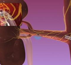 Medtronic, SYMPLICITY, SYMPLICITY HTN-3 trial, renal denervation, ACC.14