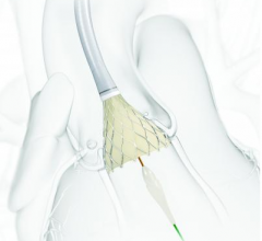 Medtronic's CoreValve Evolut R gained FDA approval for intermediate risk patients