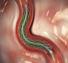 Medtronic, Drug Filled Stent, clinical trial, ACC