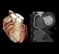 cardiac CT showing a severe right coronary artery lesion on a Toshiba Aquillion One