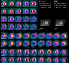 Ultraspect dose lowering software for nuclear imaging, SPECT imaging, reconstructions.
