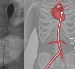 A new treatment to achieve return of spontaneous circulation (ROSC) in refractory cardiac arrest patients is the use of resuscitative endovascular balloon occlusion of the aorta (REBOA). The images show the balloon seen deployed on an angiogram and an illustration showing its placement in the aorta. 