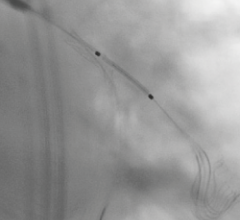 bifurcation stenting