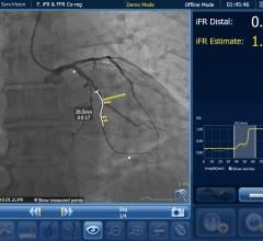 Philip's co-registration technology showing angiography overlaid with iFR in a coronary vessel segment with a system of dots that show regions where the hemodynamic pressure drops occur. This can aid in identifying culprit lesions. #TCT #TCT2020 #TCTconnect