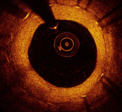 An OCT intracoronary image showing instent restenosis. The white spots in the vessel wall casting shadows are the stent struts. OCT image data might be used in the future to assess FFR to determine the severity of lesions and determine if they need to be stented.