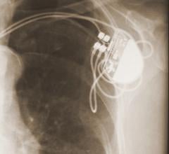 Pacemaker Lead Extraction Cook Medical