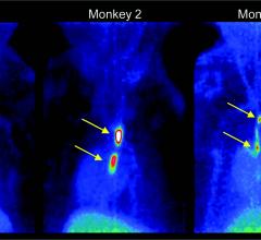 Novel PET Tracer Detects Small Blood Clots