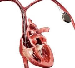occlusion, electrophysiology