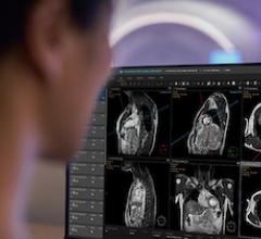 Philips, SmartHeart, cardiac MRI