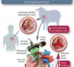 Novel Approach May Improve Valve Function in Some Patients