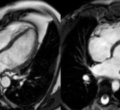regular exercise, heart enlargement, heart disease misdiagnosis, MRC Clinical Sciences Centre study