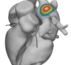 Vektor Medical has announced the release of a series of software enhancements to its AI-based non-invasive solution, vMap, which were designed to improve ablation outcomes and procedural efficiencies.