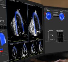 epsilon imaging echoinsight cardiac ultrasound systems mri