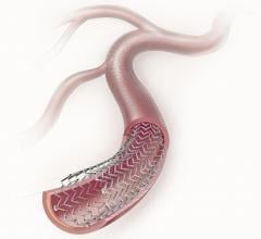 Zilver PTX Randomized Controlled Trial Stents Peripheral artery disease (PAD)