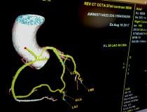 An example of GE Healthcare's software automation, which auto identifies, labels, extracts into a 3-D model and center lines all the coronary vessels.
