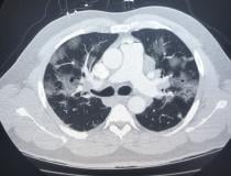 An American COVID-19 positive patient computed tomography (CT) lung scan showing ground glass lesions caused bu coronavirus pneumonia. Image from radiologist John Kim. #coronavirus