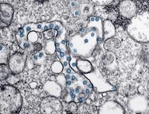 Novel coronavirus (COVID-19, SARS-CoV-2) virus as seen under a microscope in an image released by the Centers for Disease Control and Prevention (CDC). #COVID19 #SARScov22