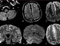 COVID-19 has been found to cause clooting in some patients, causing strokes and pulmonary embiolism. This series of images show brain MRIs in two critically ill COVID-19 patients with persistently depressed mental status including a 56-year old man (A-C), and a 64-year old man (D-F). Axial diffusion-weighted (A, D), apparent diffusion coefficient (B, E), and FLAIR (C, F) images at the level of centrum semiovale in both patients demonstrate symmetric diffuse T2/FLAIR hyperintensity (arrowheads) and mild rest