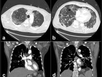 COVID-19 causes blood to clot in some patients, which can lead to pulmonary embolisms, as seen here in this COVID patient. <a href="https://www.dicardiology.com/content/new-research-highlights-blood-clot-dangers-covid-19"> Read more about this COVID complication and find more information on these images.</a> 