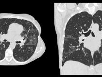 Example of a COVID-19 (SARS-CoV-2) positive patient's lung computed tomography (CT) scan. It shows the typical white, ground glass opacities (GGO) caused by COVID pneumonia. The pneumonia typically appears along the walls of each lobe of the lung, especially the chest wall and the lower portions of the lungs. This scan is from a Canon Aquilion Prime SP CT scanner and used Advanced intelligent Clear-IQ Engine (AiCE), an artificial intelligence-driven image reconstruction software to improve image quality of 