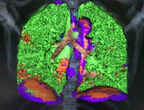 This is a COVID-19 patient's lungs as seen using Canon’s new advanced visualization lung analysis tool. It takes a patient CT scan and uses both tissue density measured with Hounsfield units and tissue texture to mark off and quantify areas of COVID pneumonia ground glass lesion consolidations. This software was cleared under an FDA emergency use authorization. The green shows areas of normal lung, and areas of red are COVID. The software can auto quantify the areas to use as a baseline to assess patients.