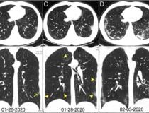 COVID pneumonia in the lungs from CT scans from China. Image courtesy of Radiology
